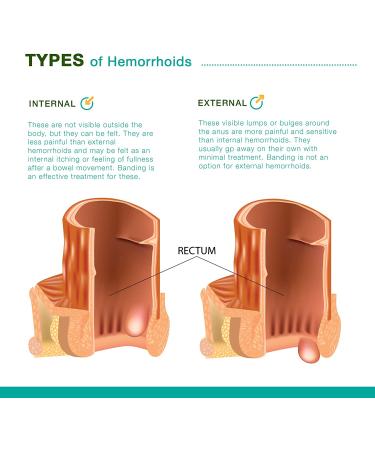 Hemorrhoid & Fissure Ointment for Fast Relief - 0.7 Ounce - Healing Formula - Pack of 1 - Buy Online on GoSupps.com
