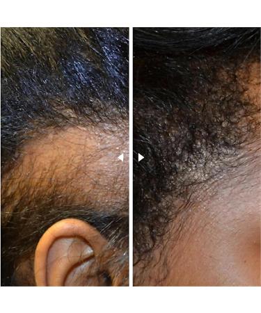 Gel d soxyribose au sucre pour la croissance des cheveux pour le traitement de la perte de cheveux favorise la repousse et r duit la croissance des cheveux gel de sucre pour cheveux (2 pi ces) 2 pi ces. - Buy Online on GoSupps.com