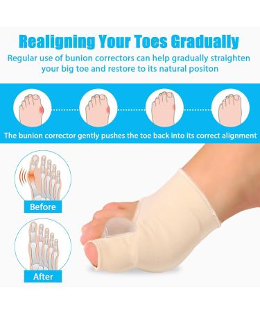 Bunion Corrector with Gel Pads - Toe Straightener Splint for Hammer Toes & Hallux Valgus - Buy Online on GoSupps.com