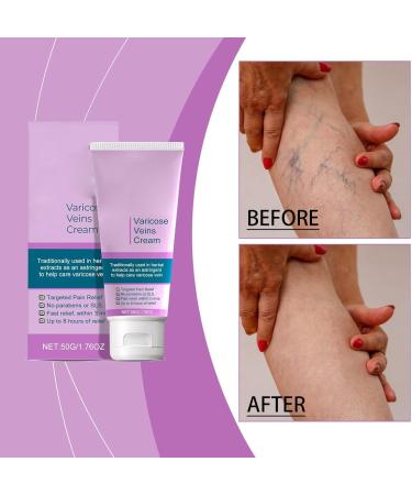 SLXYYYHW Calming Cream for Legs Anti-Varicose Veins Treatment for Legs Vitamin K Cream Miracle Cream for Varicose Veins Cream for Varicose Veins - Buy Online on GoSupps.com
