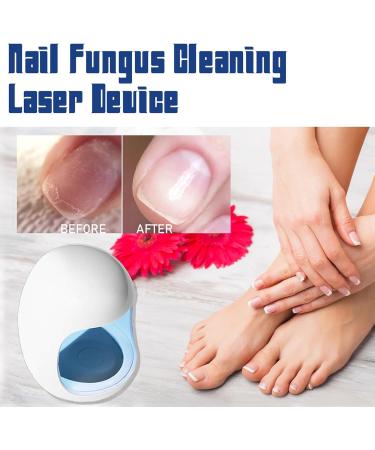 YOXIER Convenient Nail Care Device Non-invasive Fungus Treatment Cleansing Lasers Relief Easy to Operate Blue Light Therapy Infrared White - Buy Online on GoSupps.com