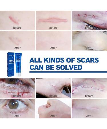 Best Scar Cream for All Types | Scar Angel - Effective Silicone Ointment for Stretch Marks & Post-Op Care - Buy Online on GoSupps.com