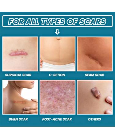 Scar Gel 20 G Effective in Treating Scars C-Section Scars Stretch Marks Acne Surgery Burns Effective On Old and New Scars - Buy Online on GoSupps.com