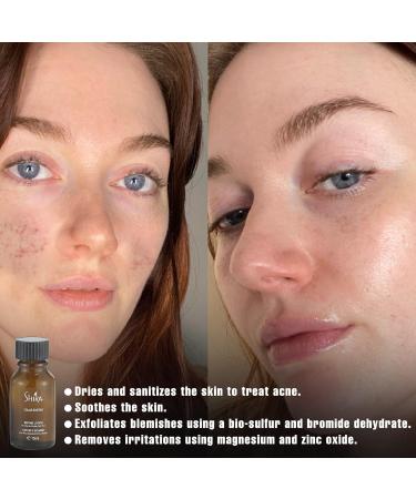 Shira Solar Energy Drying Lotion - Effective Acne Spot Treatment for All Skin Types (15ml) | Safe Pimple Treatment for Oily Skin - Buy Online on GoSupps.com