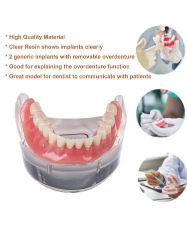 Dental Teeth Model - Lower Removable Overdenture with 2 Implants | Dentist Assistant Supplies - International Shipping - Buy Online on GoSupps.com