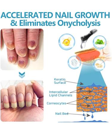 OnycholysisHeal Nail Strengthening and Growth Conditioner Nail Strengthener and Growth for Damaged Nails Strengthens & Protects Nails (4PCS) - Buy Online on GoSupps.com