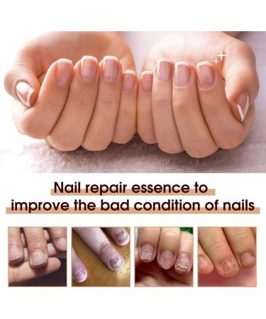 Nail Care Pen Nail Care Pen Nail Fungus Pen Health Routine Nail Care Pen Nail Care Pen Steiger Naturals Pen for Nail Fungus Against Nail Fungus Nail Care Brittle Nails Applies to All (6 Pieces) 6 pieces. - Buy Online on GoSupps.com