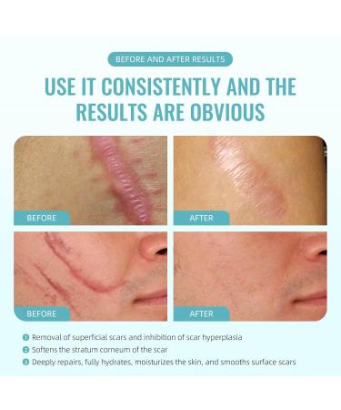 Advanced Scar Cream Gel - Effective Scar Removal for Surgical Scars Burns Acne C-Sections & More | Suitable for All Skin Types - 1.06 Oz - Buy Online on GoSupps.com