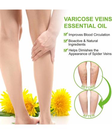 Varicose Veins & Spider Veins Essential Oil for Improved Leg Circulation - 30ML - Buy Online on GoSupps.com
