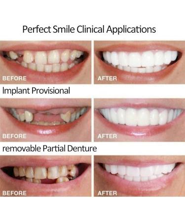 Temporary Dental Veneers for Natural Teeth Restoration - Upper & Lower Jaw, Natural Shade - Buy Online on GoSupps.com