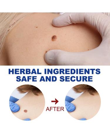 Maximum Strength Wart Removal Cream with Salicylic Acid - Fast-Acting Gel for Genital Plantar Common & Flat Warts - 1PC - Buy Online on GoSupps.com