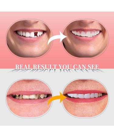 Snap-On Veneers for Men and Women - 2PCS Temporary Fake Teeth to Cover Imperfections - No Pain, No Shot, No Drilling - White (C05) - Buy Online on GoSupps.com