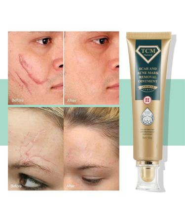 Scar Removal Cream - 30g - Fade Scars, Stretch Marks & Burns - Moisturizing Facial Skin Repair Treatment - Buy Online on GoSupps.com