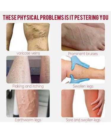 Varicose Vein Relief Cream Set - Auquest Treatment for Legs with Patches - Spider Veins Repair - Buy Online on GoSupps.com