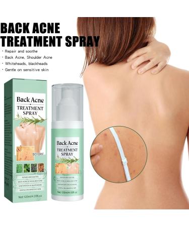 Back Acne Treatment Spray Acne Treatment Spray Acne Moisturiser for Back Body Body Acne Treatment Acne Back Treatment Back Spray Acne Body Acne Spray Back Acne Treatment Acne Body Spray 120ml - Buy Online on GoSupps.com