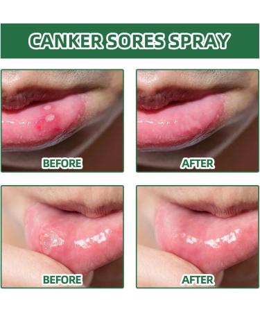 Mouth Bleeding Spray & Ulcer Treatment - Calming Mouth & Throat Spray (20ml) | Fast Relief for Mouth Wounds & Salivation - Buy Online on GoSupps.com