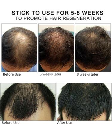 Ginger Hair Growth Oil Hair Growth Oil for Men Hair Growth Advanced Hair Booster Fast Hair Growth Dense Oil for Women and Men - Buy Online on GoSupps.com