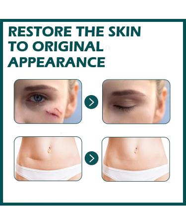 MIELIKKI Silicone Scar Sheets - Reusable 1.6x120 Roll for Scar Removal from Acne, C-Sections, Burns, and Surgery - Post Surgery Supplies - Buy Online on GoSupps.com