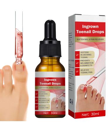 Ingrown Toenail Treatment, Ingrown Toenail Pain Relief, Natural Ingrown Toenail Correction Treatment, Easy Trimming Toenail Softening Drops, 30ml 30ml (1 bottle)