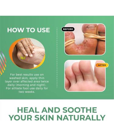 Skin Hero Athlete's Foot Cream 50g - Extra Strong Anti-Fungal Treatment - Buy Online on GoSupps.com