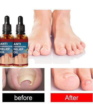 Ingrown Toenail Treatment Oil - 2PCS | Anti-Paronychia Relief & Ingrown Toenail Correction Drops - Buy Online on GoSupps.com