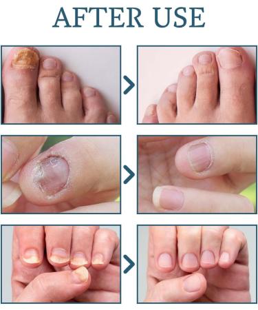 Fungal Nail Treatment - Extra Strong Nail Fungus Treatment for Toenail and Fingernail - Fungal Nail Eliminator Anti fungus Nail Repair and Strengthen Fix & Renew Damaged Broken Nails 30ml - Buy Online on GoSupps.com