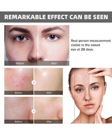 Niacinamide10%+Zinc 1% & Hyaluronic Acid 2% + B5 Skincare Serum Set Hyaluronic Acid Serum for Face Niacinamide Serum Moisturiser Face Anti Aging Serum for Face Minimises Pore Brightening Serum - Buy Online on GoSupps.com