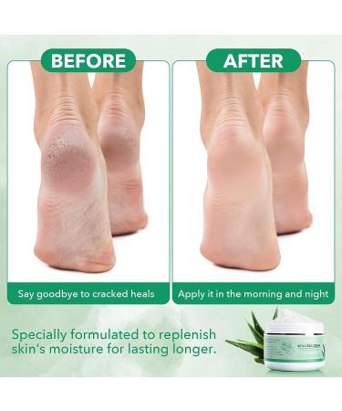 Urea Cream 40% with Salicylic Acid, Vitamin E, Aloe Vera, Hyaluronic Acid - 7 oz - Intensive Moisturizer for Dry Cracked Feet, Hands, Heels, Elbows, Nails, Knees - Buy Online on GoSupps.com