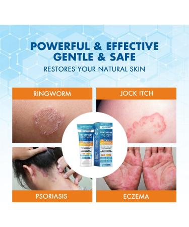 Hermon Antifungal Ringworm Cream - 100ml | Treat Ringworm Jock Itch Eczema & Athlete's Foot for Adults & Kids - Buy Online on GoSupps.com