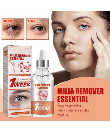KOAHDE Milia Removal Face Serums Milia Spot Treatment Milia Treatment Spot Remover for Face Speedy Milia Remover Milia Spot Ruduce Face Serums Dark Spot Remover Face Serum Milia Removal Spot Care - Buy Online on GoSupps.com