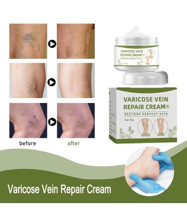 Varicose Veins Cream - Repair Spider Veins & Leg Treatment (50g) | Effective Relief for Healthy Legs - Buy Online on GoSupps.com