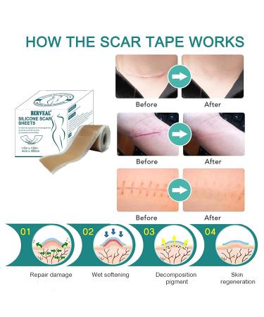 Silicone Scar Tape Roll - Easy-Tear Gel Tape for Surgery Scars - 1.6 x 120 Inch - Medical Grade Silicone Sheets - Wound Dressing for Scar Management - Buy Online on GoSupps.com