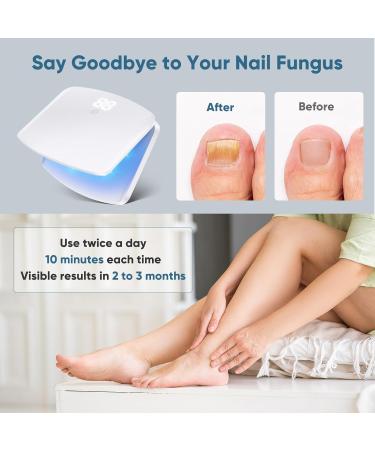 Nail Fungus Light Device for Onychomycosis - Safe & Effective Home Use for Toenail & Fingernail Solutions - Buy Online on GoSupps.com