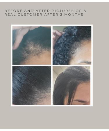 TRESSCURE DHT Blocker Hair Growth Serum | Fuller Thicker Hair in 90 Days | No Oily Residue | International Shipping Available - Buy Online on GoSupps.com