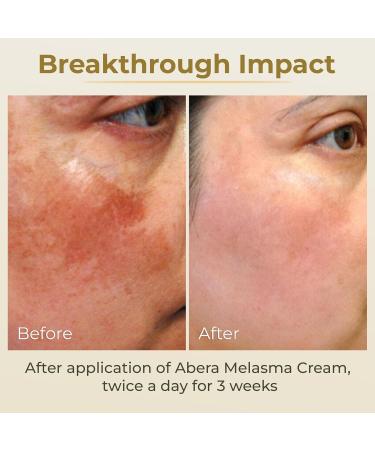 ABERA Melasma Cream (Premium Version) - Cream for Skin Care and Hydration Promoting Radiant and Healthy-Looking Skin Suitable for Sensitive Skin (1 Box + Gift) - Buy Online on GoSupps.com