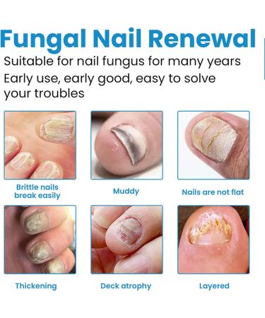 WJnflQN Nail StrengtheningFoot Nail Nourishing Spray 100ml Nonsticky Strengthening Spray for Damaged Cracked Brittle Nails for Daily Hand and Foot Care - Buy Online on GoSupps.com