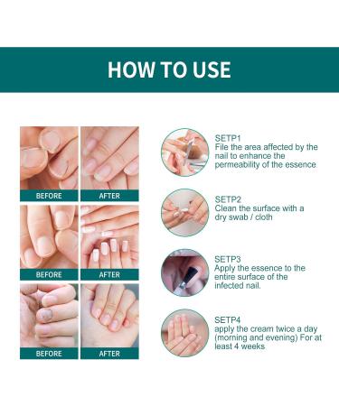 Anti-Fungal Nail Treatment Kit with Nail Clippers & Glass Nail File - Natural Ingrown Toenail Correction & Fungal Nail Repair - 2 in 1 Nail Care Solution - Buy Online on GoSupps.com