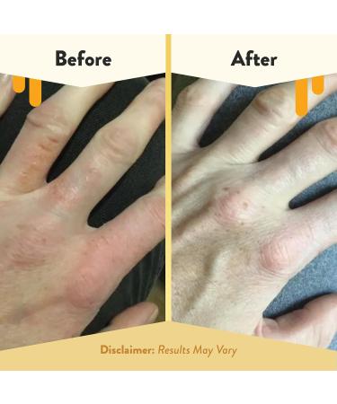 ECZEMA HONEY Oatmeal Hand Cream - Natural Hand & Body Lotion for Eczema Rash Relief - Eczema Cream for Dry Itchy Sensitive & Irritable Skin (2 Oz) 2 Ounce (Pack of 1) - Buy Online on GoSupps.com