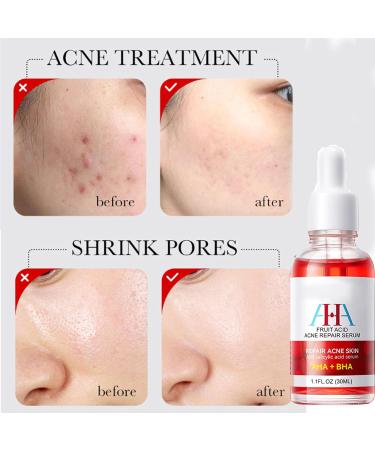 Friut Acid Face Serum for Acne Mark Salicylic Acid Anti Wrinkle Serum Fade Ance Mark & Shrink Pore Face Serum Hyaluronic Acid Acne Repair Serum for Sensitive Skin Smoothing Hyaluronic Serum-30ml - Buy Online on GoSupps.com