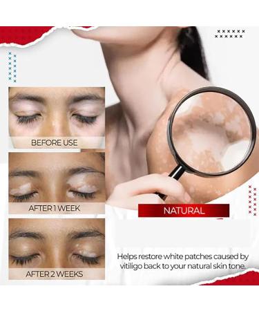 DUBUSH Vitiligo Relief Spray - Psoriasis & Pigmentation Regulating Treatment, Reduces White Spots on Skin - 3 Pack - Buy Online on GoSupps.com