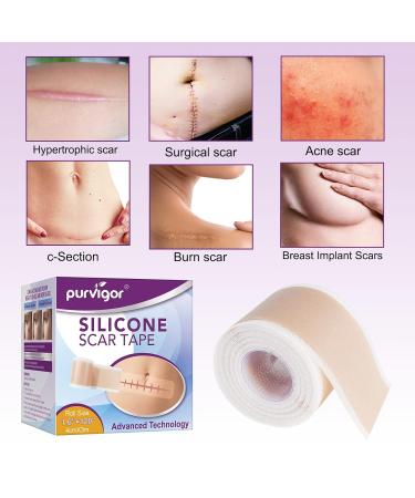 Soothing Silicone Scar Sheets Roll for C-Section, Surgery, Burns, Acne, Stretch Marks - 1.6 x 120 in - Reusable & Effective - Keloid Reduction - Buy Online on GoSupps.com