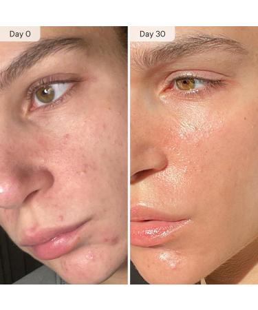 Qure Micro Infusion System for Face & Neck - Facial Moisturizing Essence Hydrating Serum for All Skin Types Refreshed Skin - 3-Month Supply 3 Month - Buy Online on GoSupps.com