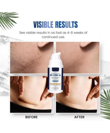 Kipisisne SilVive Advanced Silicone Skin Renewal Gel - Surgical & Acne Scar Removal, Stretch Mark Treatment - Medical Grade Formula for All Skin Types - 3pcs - Buy Online on GoSupps.com
