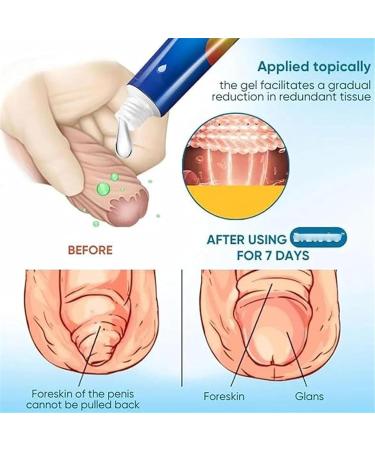 gupeouee BruteCo Redundant Prepuce Corrector Gel Professional Redundant Prepuce Corrector GelForeskin Correction Gel with Natural Fast and Gentle Action Effective Relief 2Pcs - Buy Online on GoSupps.com