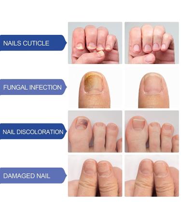 Fungus Nail Treatment - Extra Strength Toenail & Fingernail Repair Solution - Buy Online on GoSupps.com
