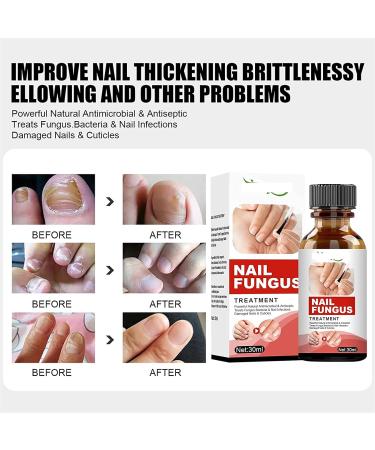 TLOPA Intense Nail Growth and Strengthening Serum 7 Days Nail Growth and Strengthening Serum Nail Serum Repair Essence for Damaged Nails (3Pcs) - Buy Online on GoSupps.com