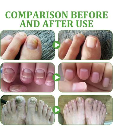 Nail Strengthener for Nail Growth Treatment Keratin 3 Day Growth Nail Treatment & Strengthener Nail Strengthener for Damaged Nails Nail Hardener for Weak Nails - Buy Online on GoSupps.com