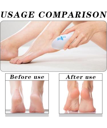Creative Egg Foot Grinder Portable Egg Callus Remover Durable Manual Pedicure Tools for Dead Skin Removal White Highly Effective Callus Remover Wake up Velvety Feet for Foot Spa Home Salon - Buy Online on GoSupps.com