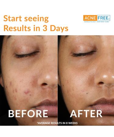 Acnefree 24 Hour Acne Clearing System Kit - Pack of 6 | International Shipping Available - Buy Online on GoSupps.com