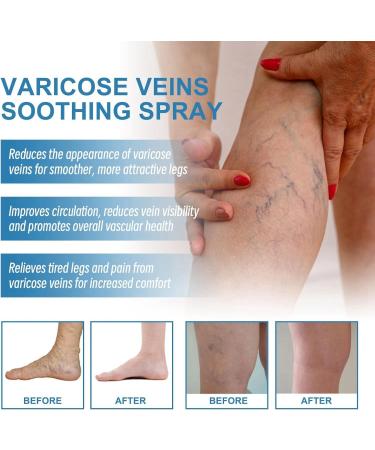 Varicose Veins Cream - Spider Veins Repair & Treatment for Legs | Relief Ointment - Buy Online on GoSupps.com